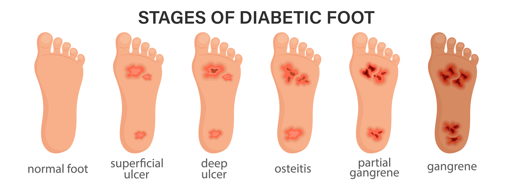 diabeticfoot