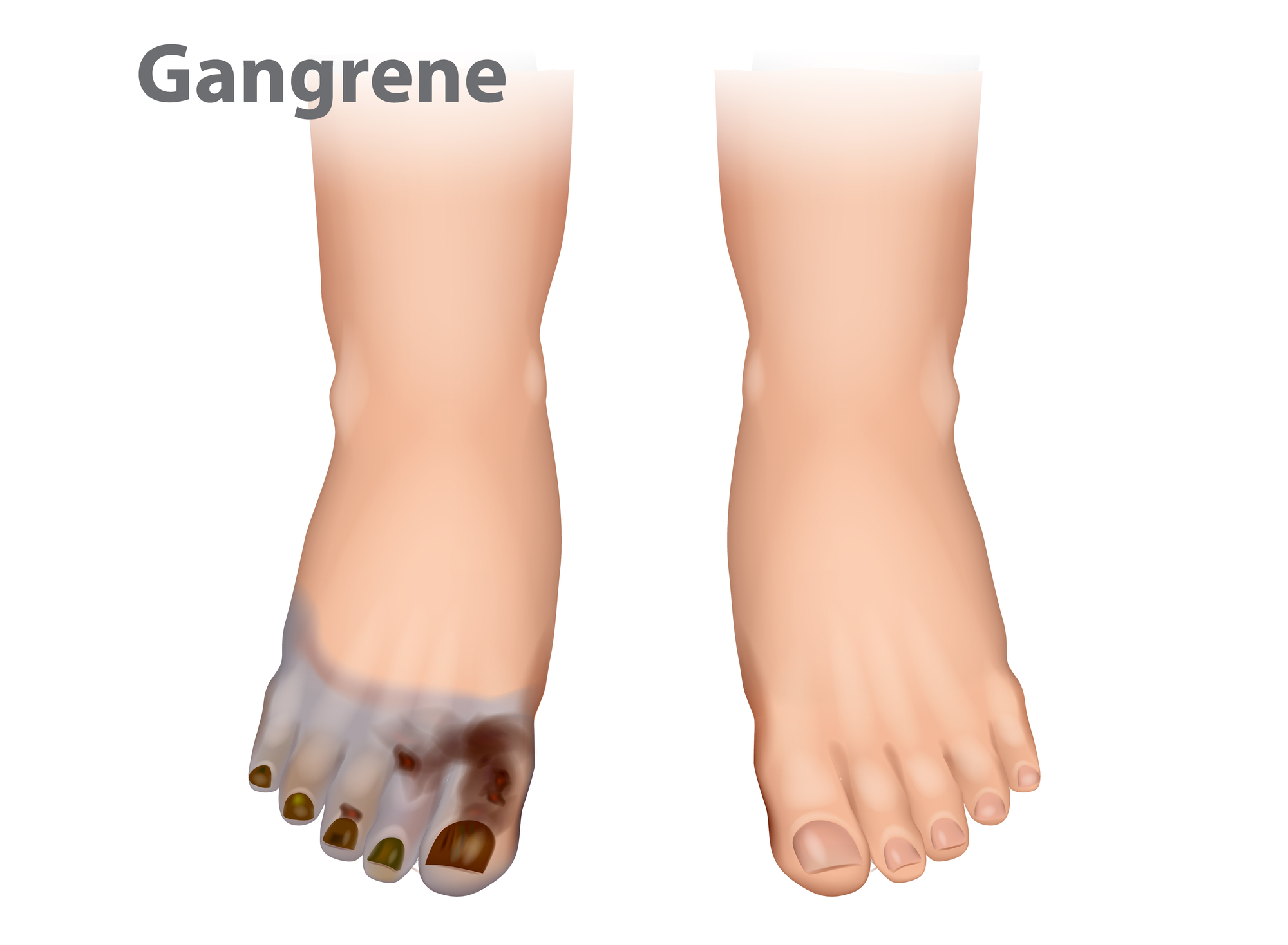 diabetic gangrene